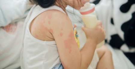 O microbioma da criança com alergia ao leite, ovo e amendoim