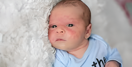 Dupilumab eficaz no tratamento do eczema moderado a grave em crianças