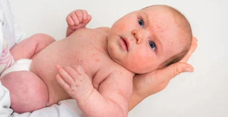 86,4 % dos bebés com anafilaxia receberam epinefrina devidamente