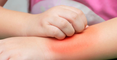 Alterações na microbiota intestinal precedem o desenvolvimento de eczema na infância